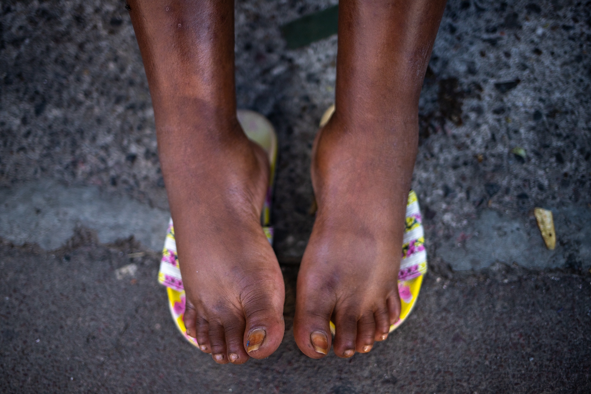Con 25 años de edad y 8 meses de embarazo, la haitiana Edlin anduvo durante cinco días con los pies inflamados. Comayagüela, 26 de octubre de 2021. Foto: Martín Cálix.